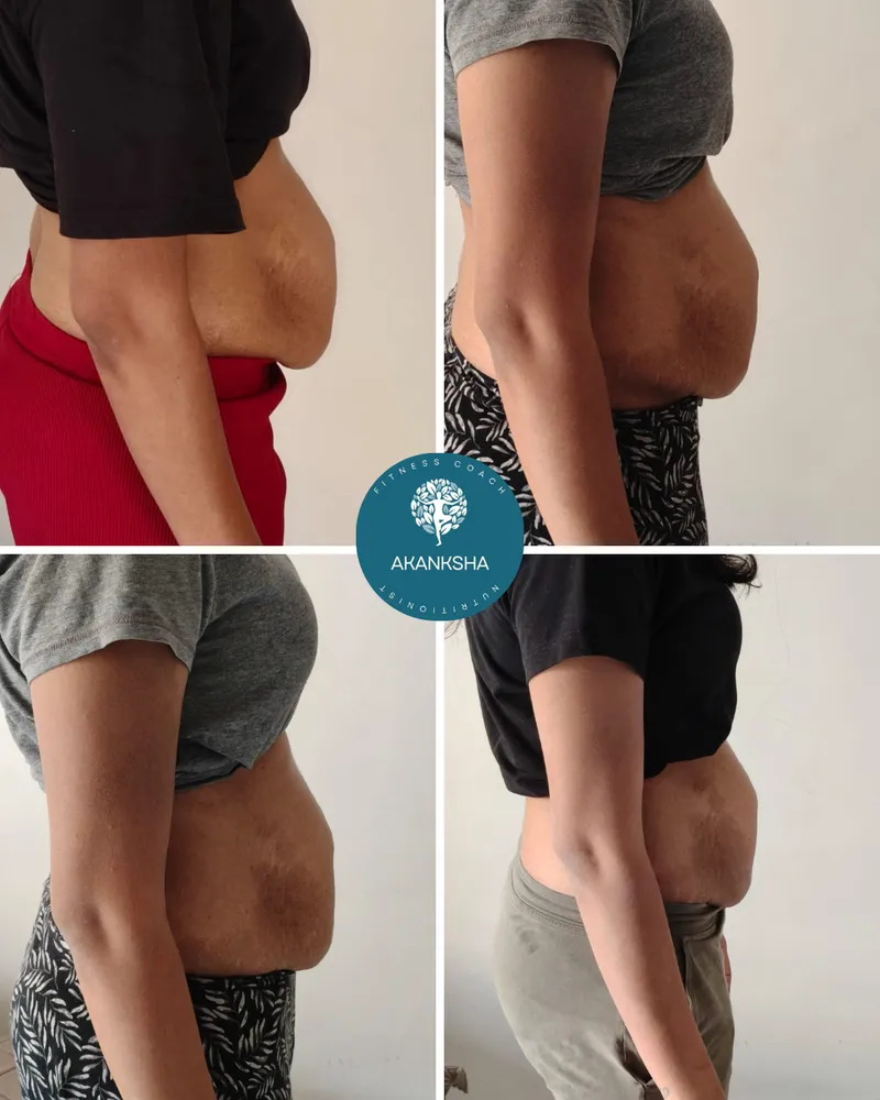 Side before-and-after of a client's core and Diastasis Recti recovery (identity protected).