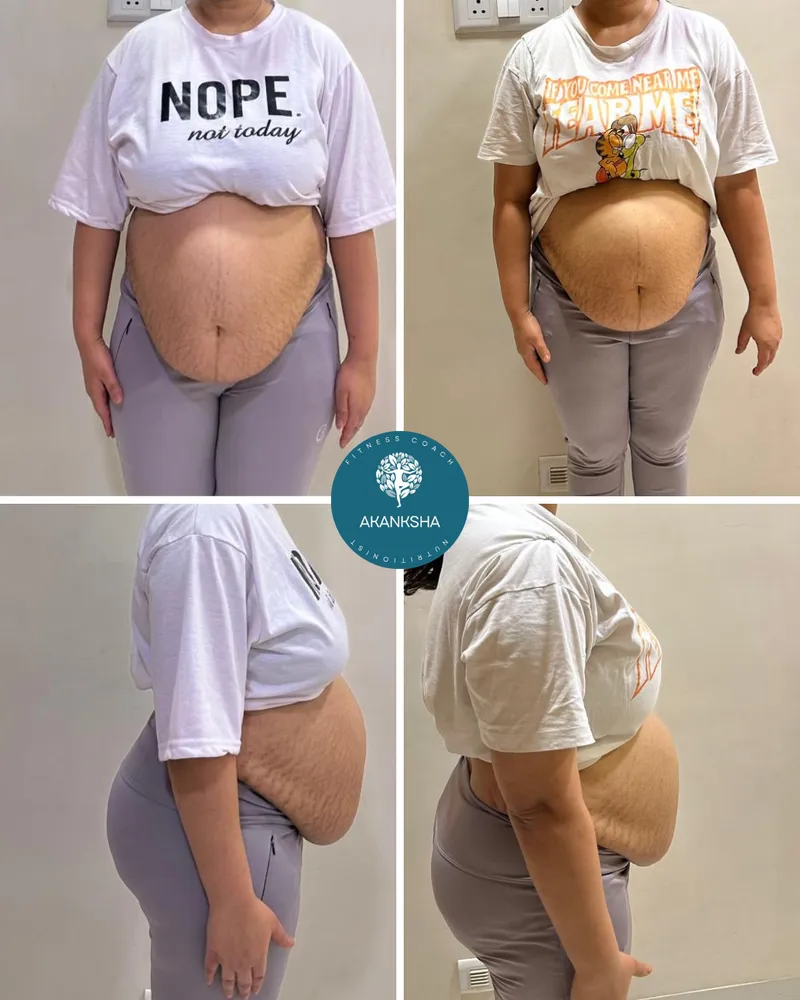 Front-and-side before-and-after of a client's postpartum belly after a recovery programme (identity protected).